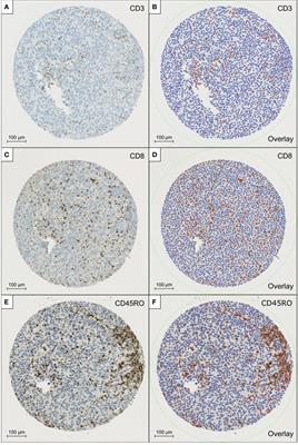 Modified immunoscore improves the prediction of progression-free survival in patients with non-muscle-invasive bladder cancer: A digital pathology study